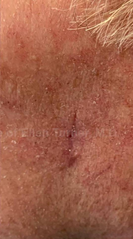 Cyst Removal Before and After Case-48 After