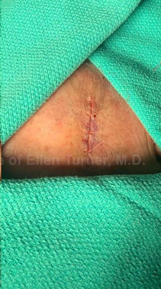 Cyst Removal Before and After Case-52 After