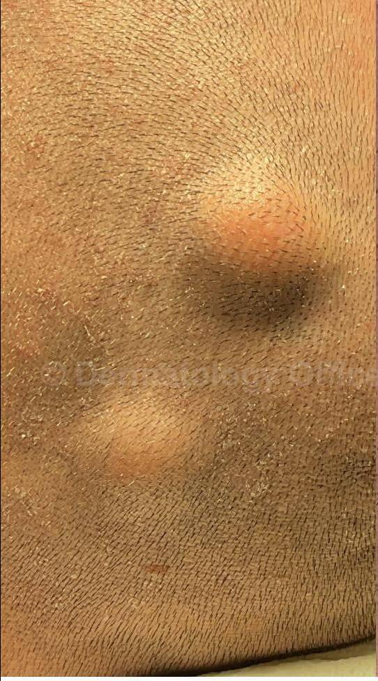 Cyst Removal Before and After Case-51 Before