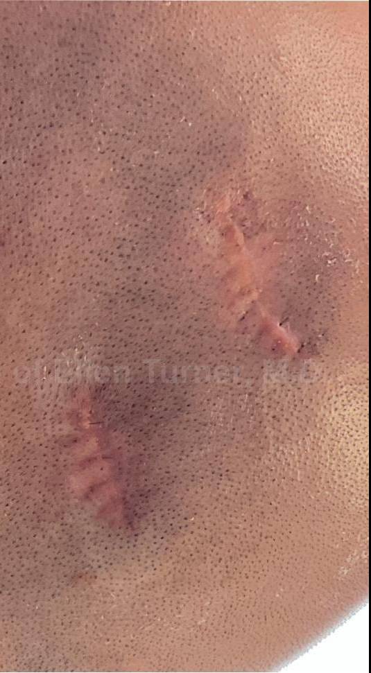 Cyst Removal Before and After Case-51 After