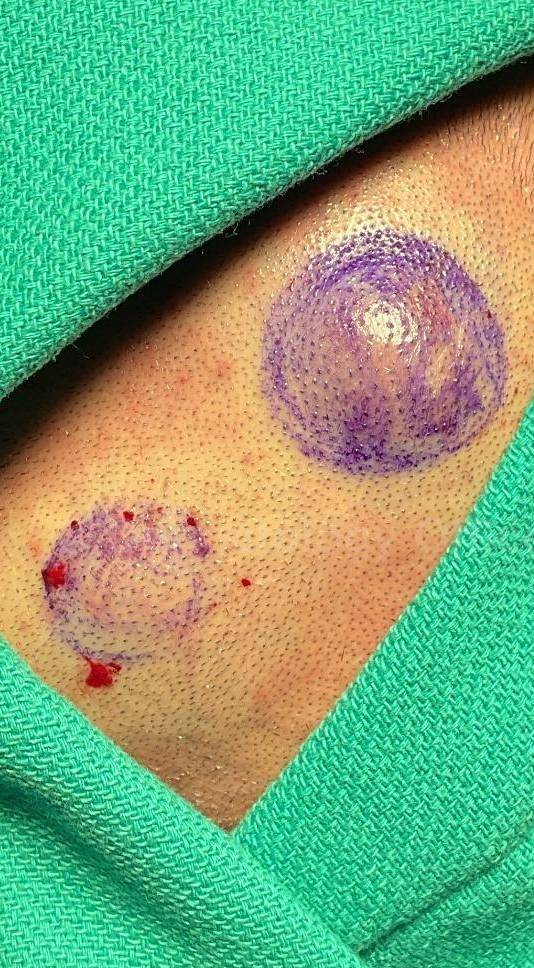 Cyst Removal Before and After Case-50 Before