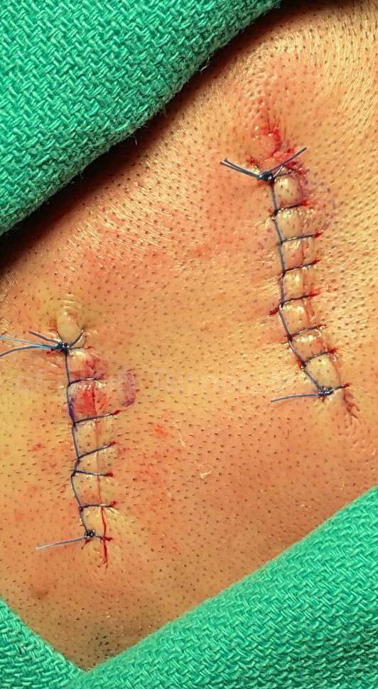 Cyst Removal Before and After Case-50 After