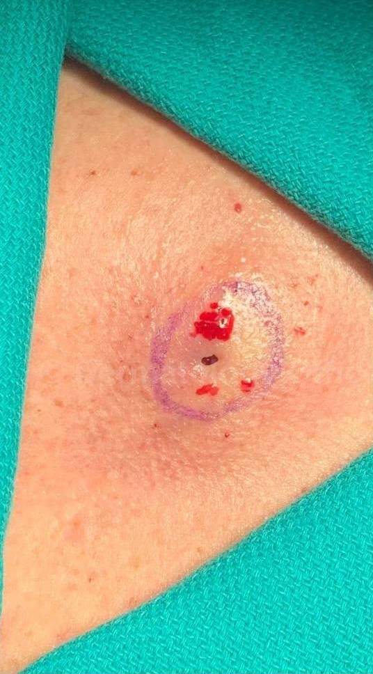 Cyst Removal Before and After Case-49 Before