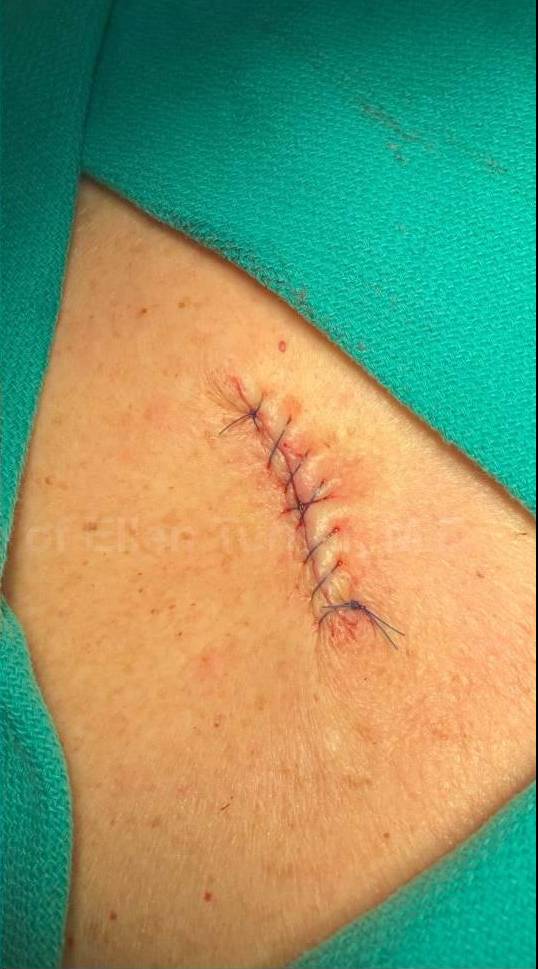 Cyst Removal Before and After Case-49 After