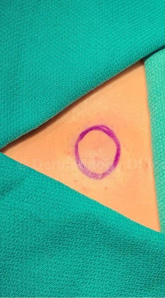 Cyst Removal Before and After Case-47 Before