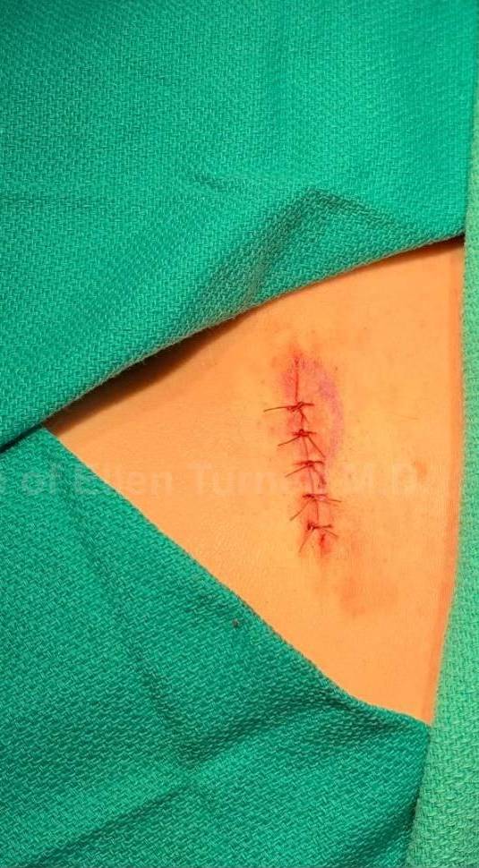 Cyst Removal Before and After Case-47 After