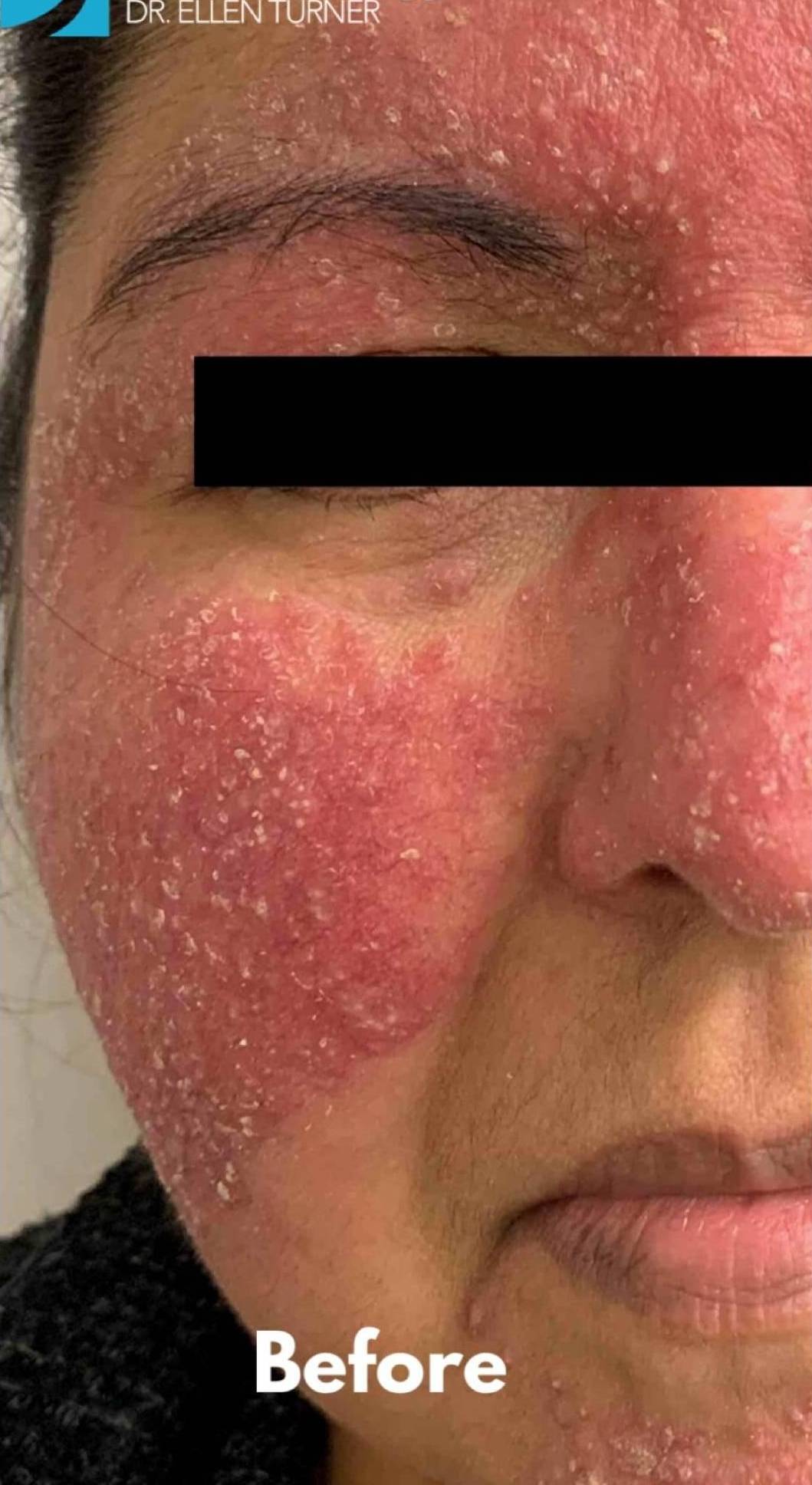 Atopic Dermatitis Before and After Case 1 Before