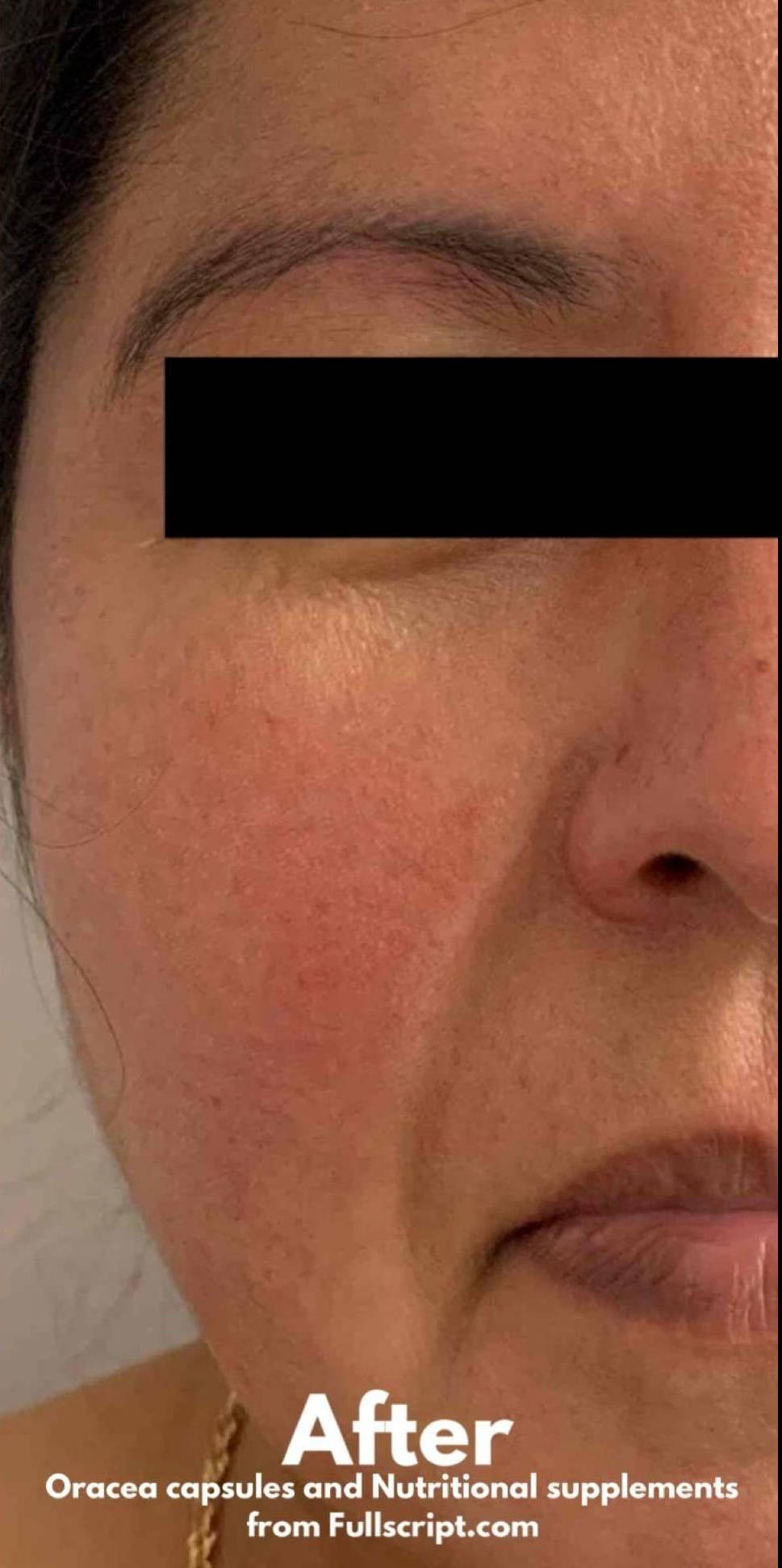 Atopic Dermatitis Before and After Case 1 After
