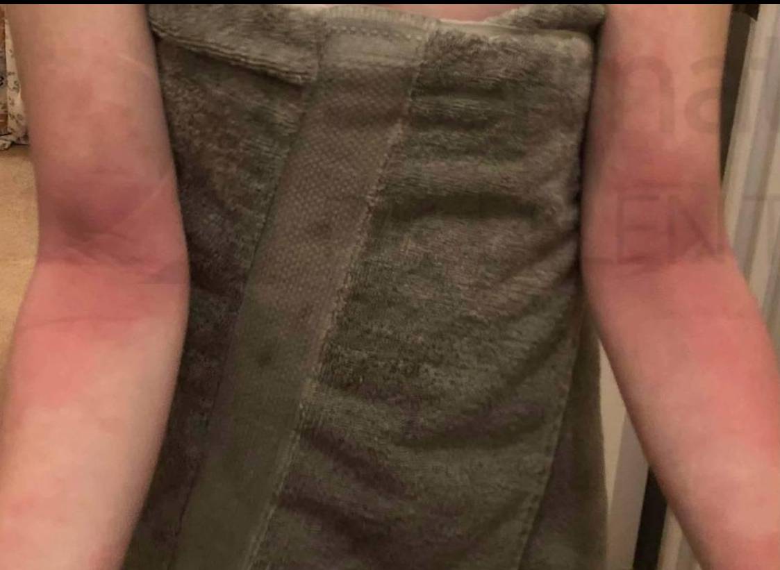 Eczema/ Atopic Dermatitis (3 Weeks Dupixent) Case-21 Before