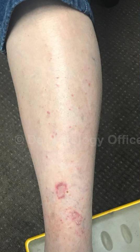Eczema/Atopic Dermatitis Case 37 Before