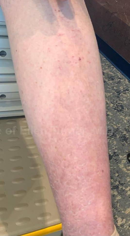 Eczema/Atopic Dermatitis Case 37 After