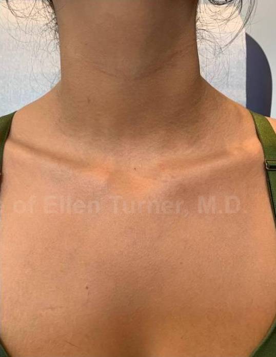 Eczema/Atopic Dermatitis Case 38 After