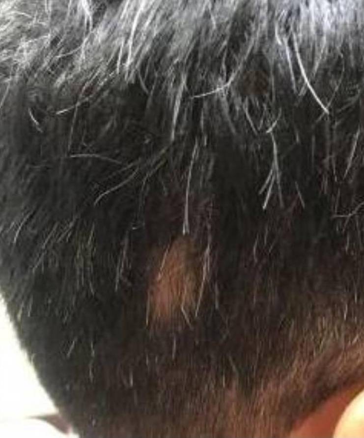Hair Loss Before and After Case 1 After