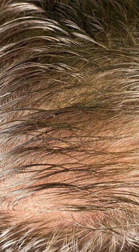 Hair Loss Before and After Case-15 Before