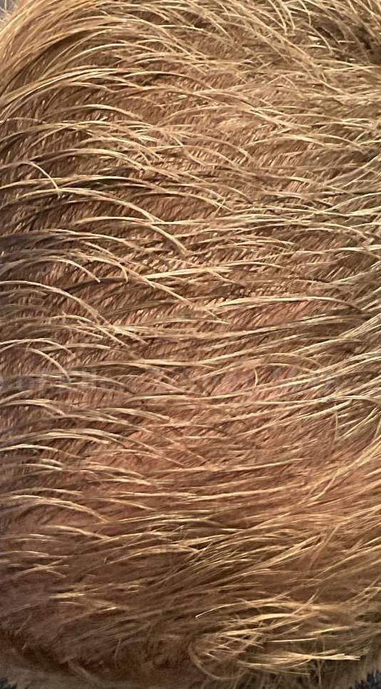Hair Loss Before and After Case-15 After