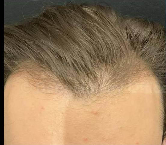 Hair Loss Before and After Case-16 Before