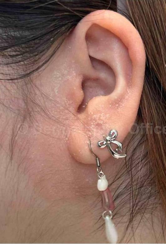 Psoriasis Before and After Case 60 Before