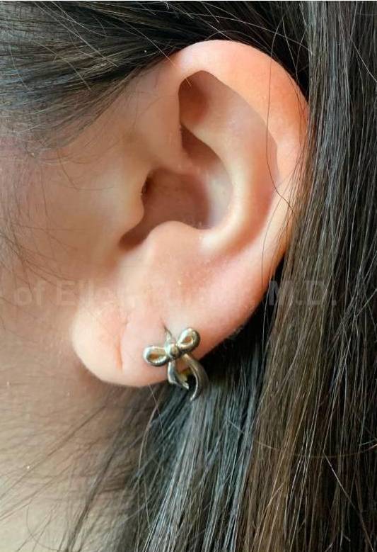 Psoriasis Before and After Case 60 After