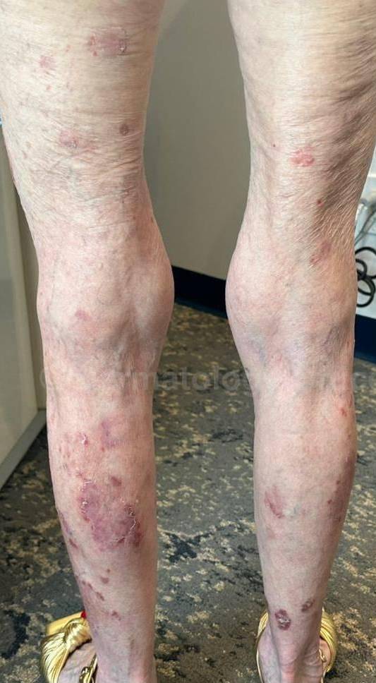 Psoriasis Before and After Case 61 Before