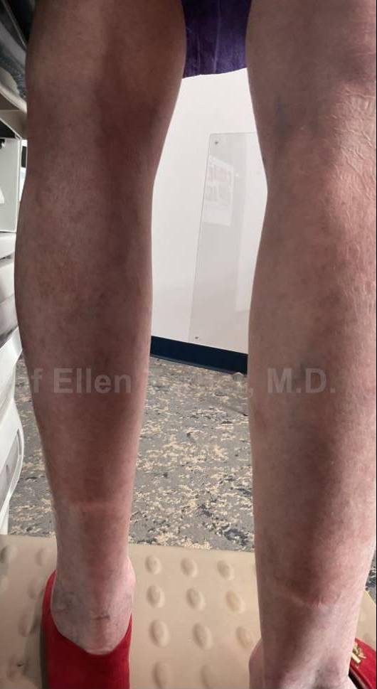 Psoriasis Before and After Case 61 After