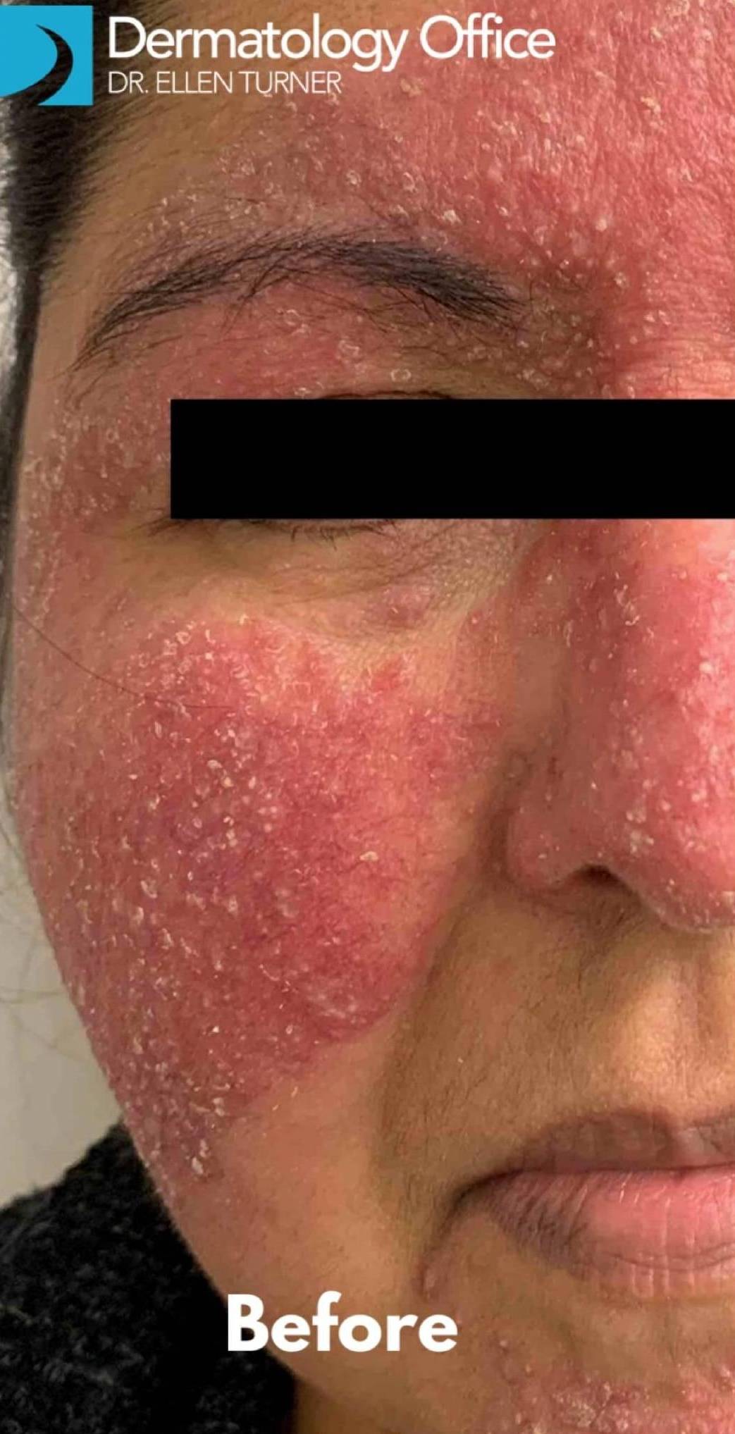 Rosacea Before and After Case 2 Before