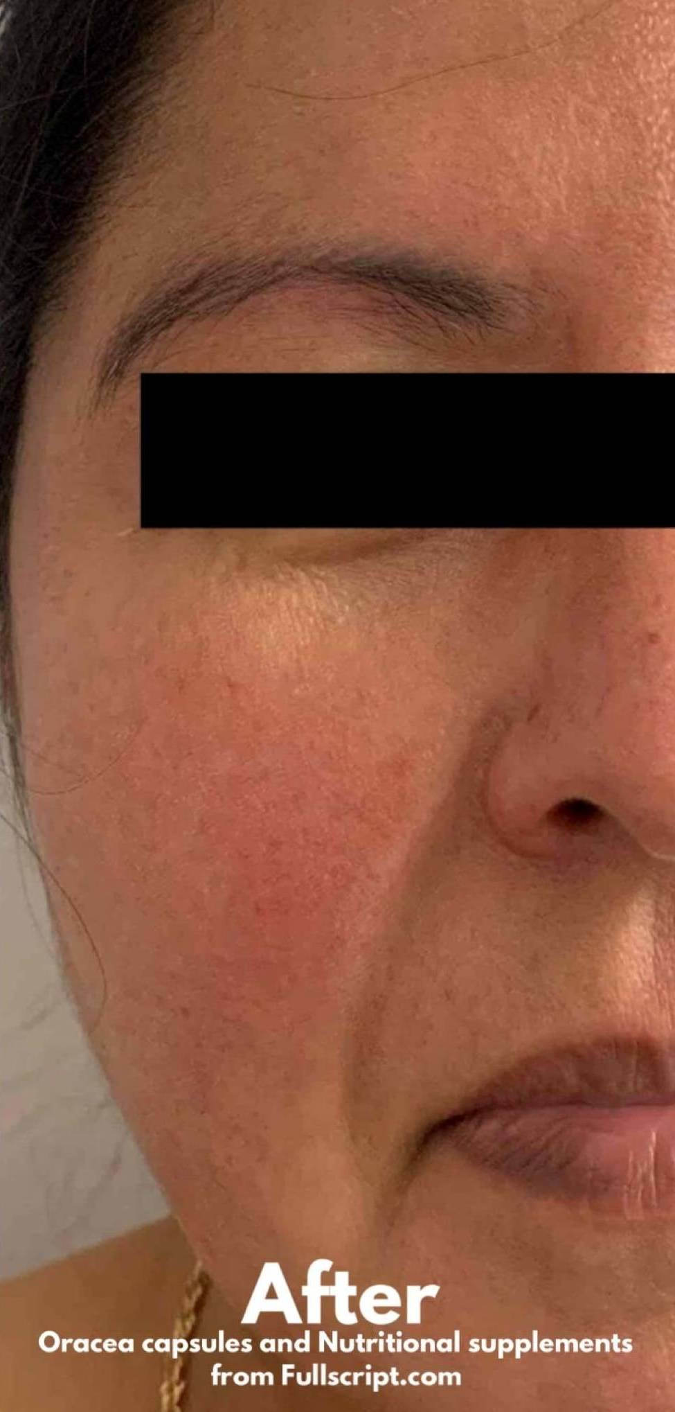 Rosacea Before and After Case 2 After