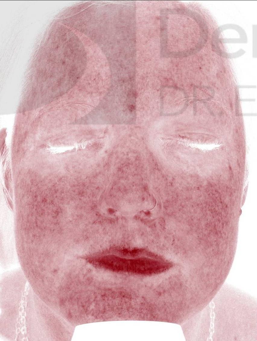 Colorescience Rosacea Study Case-7 Before