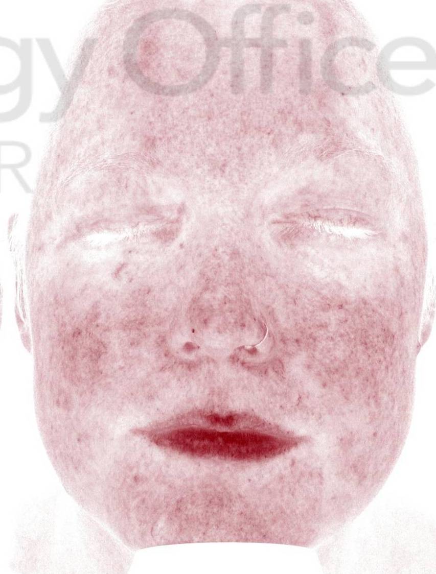 Colorescience Rosacea Study Case-7 After