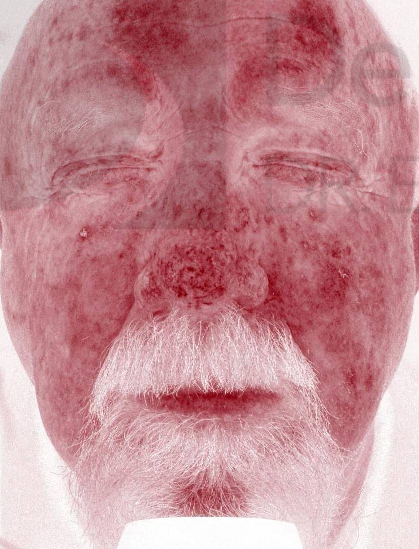 Colorescience Rosacea Study Case-8 Before