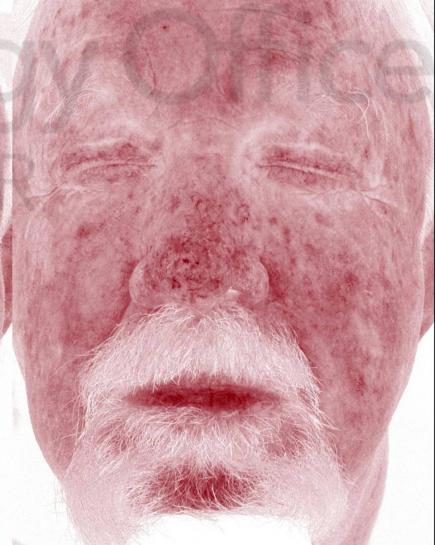 Colorescience Rosacea Study Case-8 After