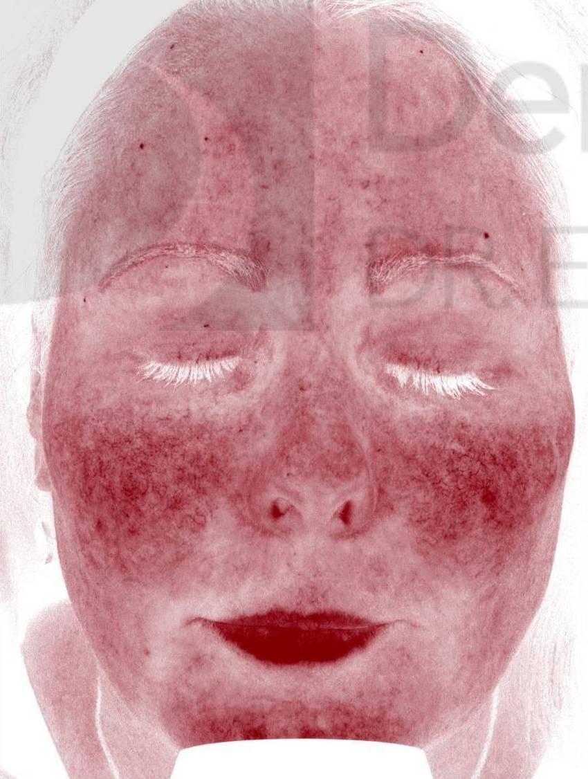 Colorescience Rosacea Study Case-9 Before