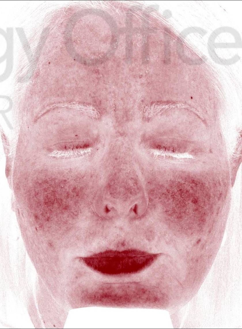 Colorescience Rosacea Study Case-9 After