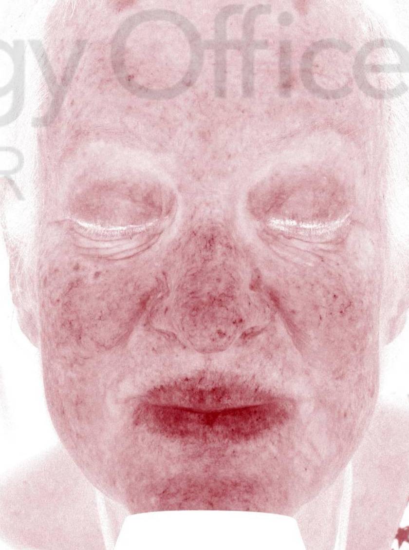 Colorescience Rosacea Study Case-12 After