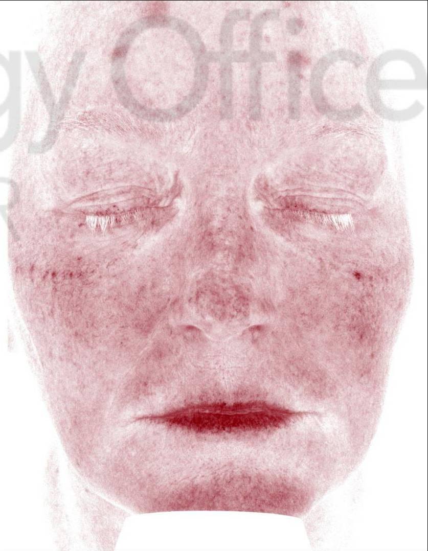 Colorescience Rosacea Study Case-13 After