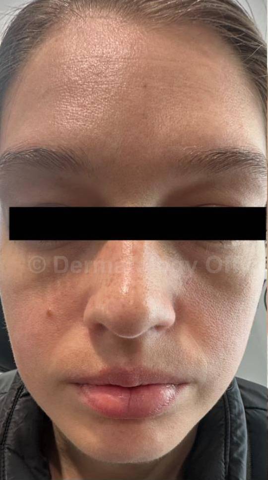 Rosacea Before and After Case-15 Before