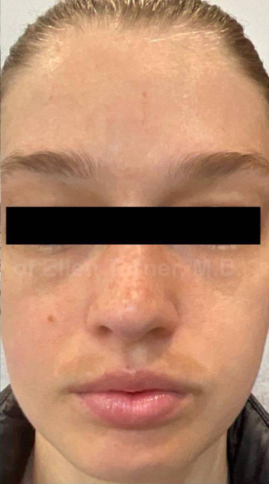 Rosacea Before and After Case-15 After