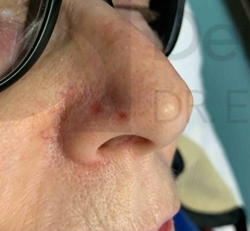 Skin Cancer (18 Treatments Radiation) Case-35 Before