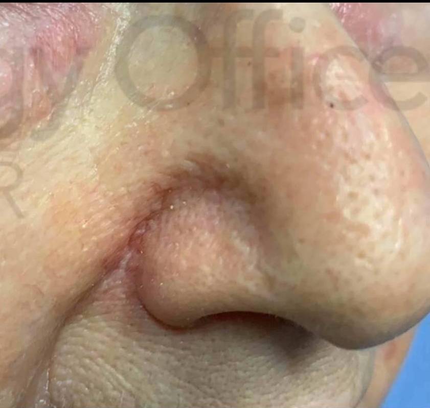 Skin Cancer (18 Treatments Radiation) Case-35 After