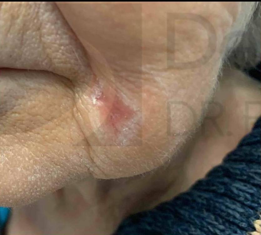 Skin Cancer (17 Treatments Radiation) Case-36 Before