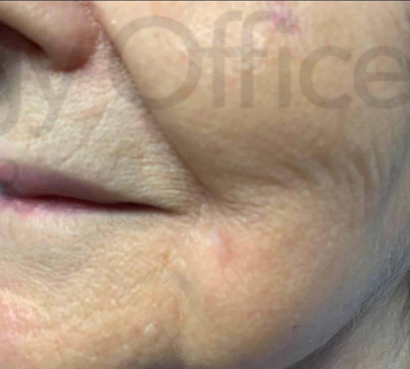 Skin Cancer (17 Treatments Radiation) Case-36 After