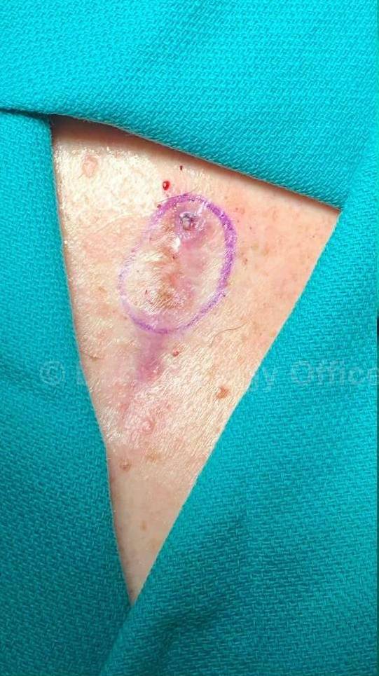 Skin Cancer (Excision) Case-110 Before