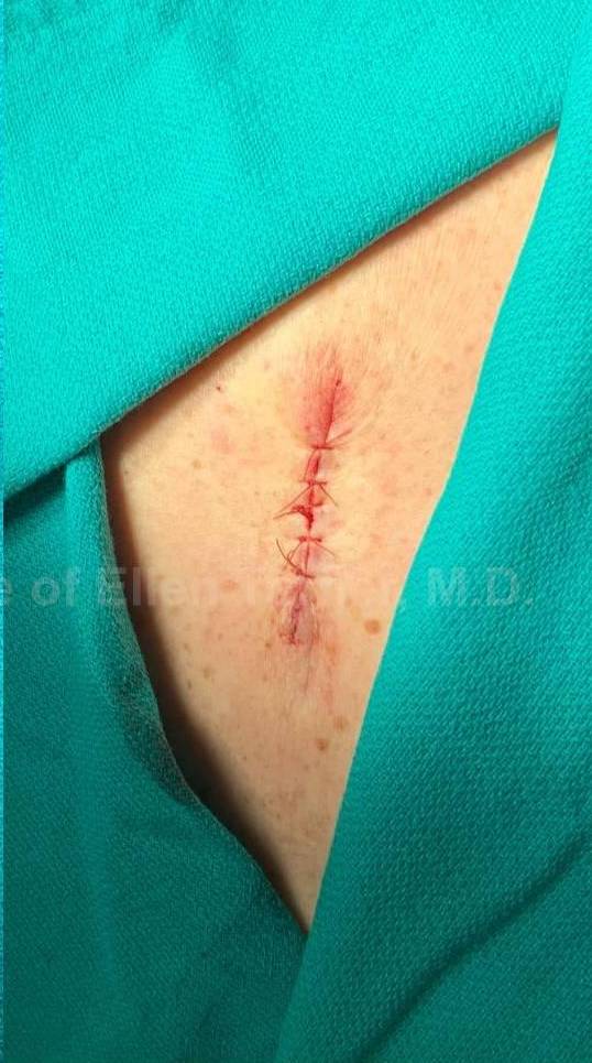 Skin Cancer (Excision) Case-110 After