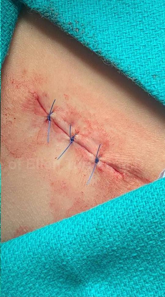 Skin Cancer (Excision) Case-109 After