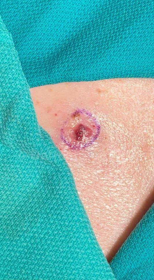 Skin Cancer (Excision) Case-108 Before