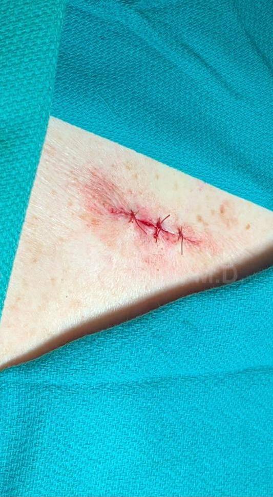 Skin Cancer (Excision) Case-108 After