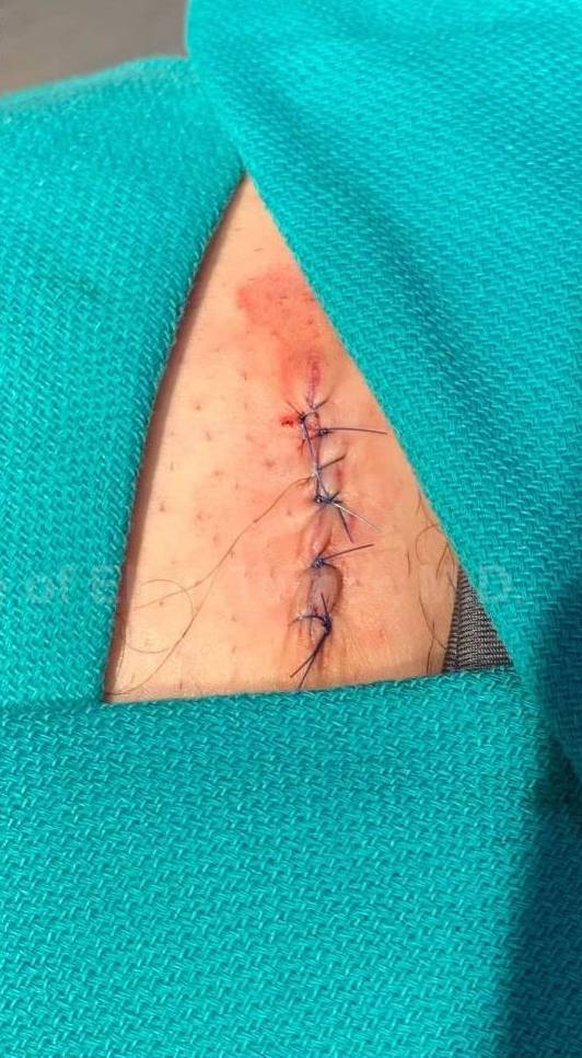 Skin Cancer (Excision) Case-107 After