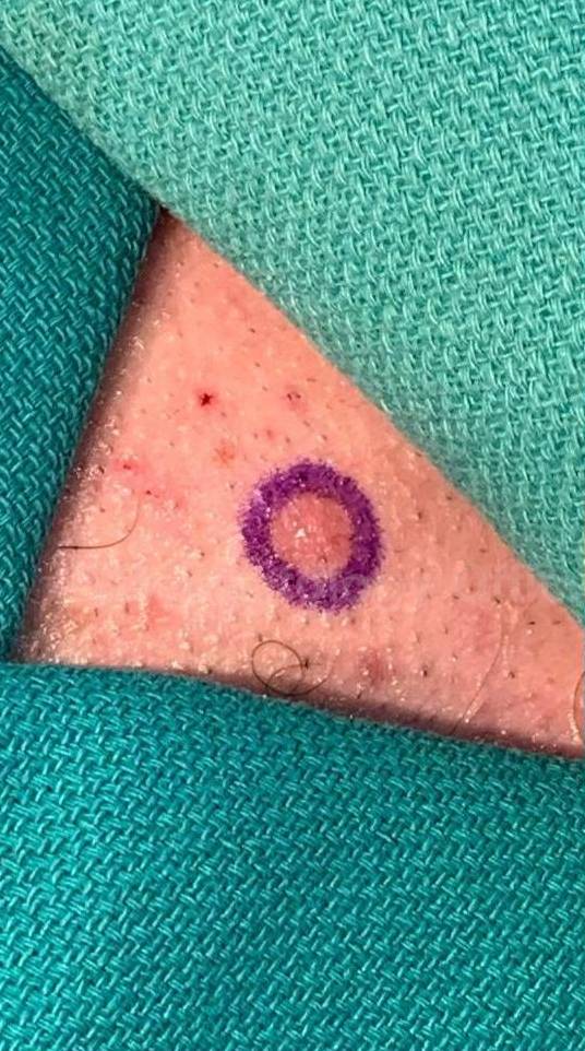 Skin Cancer (Excision) Case-106 Before