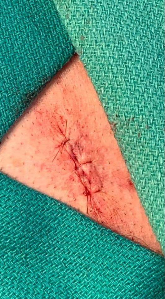 Skin Cancer (Excision) Case-106 After