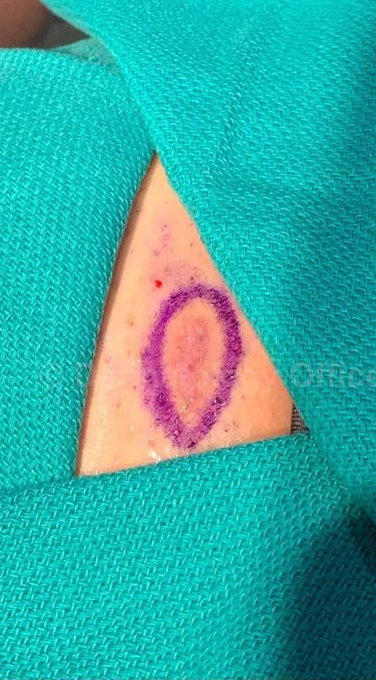 Skin Cancer (Excision) Case-105 Before