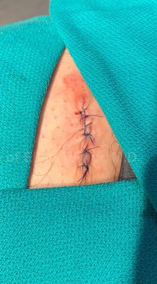 Skin Cancer (Excision) Case-105 After